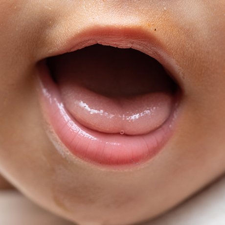 Closeup of infant in need of ankyloglossia