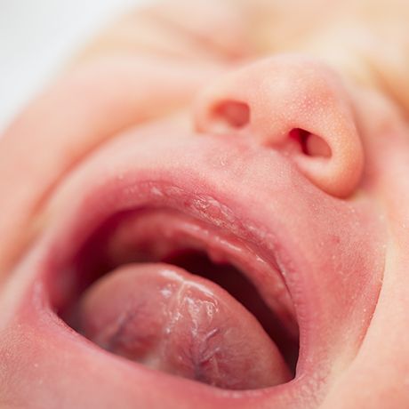 Closeup of infant in need of tongue tie treatment