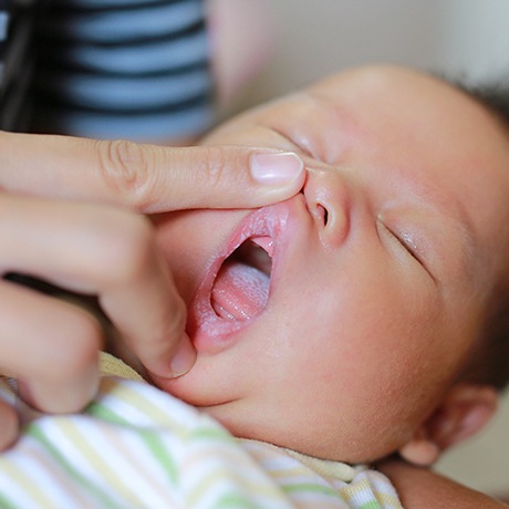 Dentist examining baby before lip tie treatment