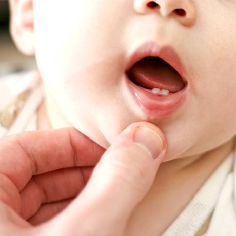 Examining infant in need of lip and tongue tie treatment