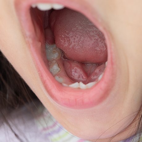 Closeup of infant in need of buccal tie treatment