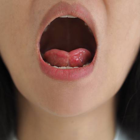 Closeup of child with tethered oral tissues