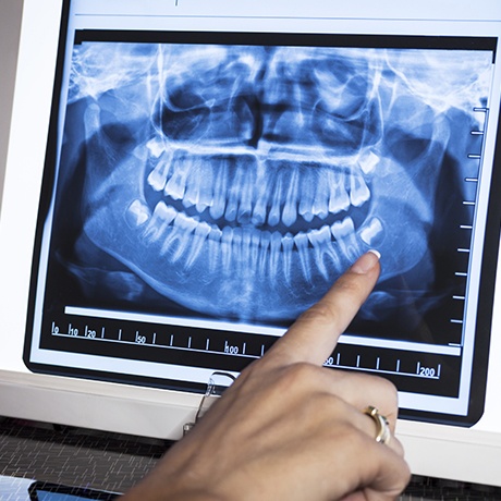 Digital dental x-rays on chairside computer