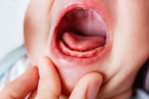 closeup of a baby’s mouth with infant acid reflux