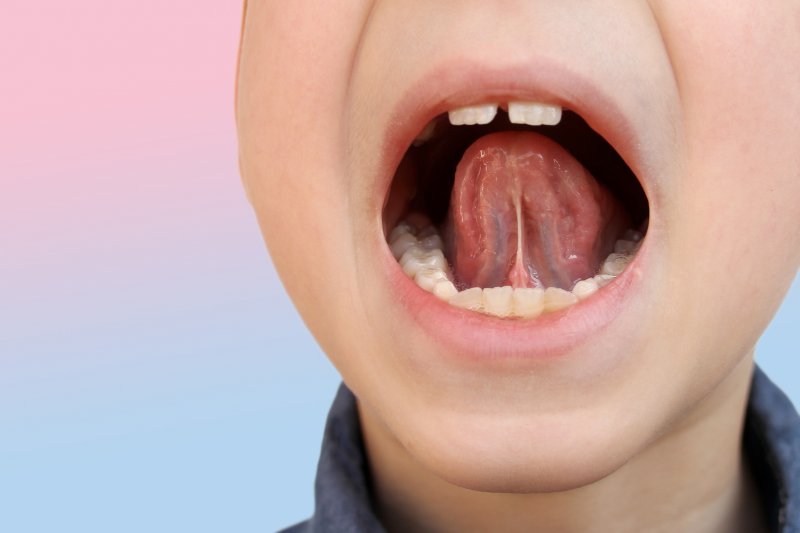 child with a tongue tie