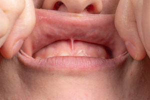 closeup of a person’s frenulum