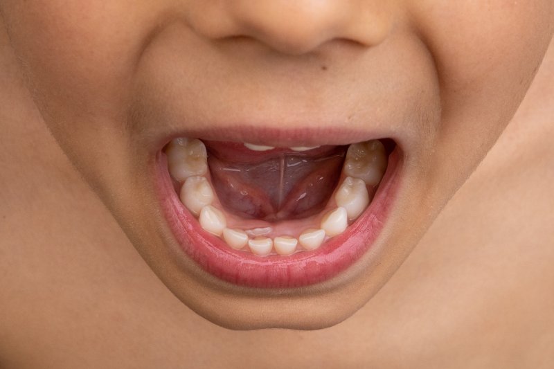 child’s tongue-tie